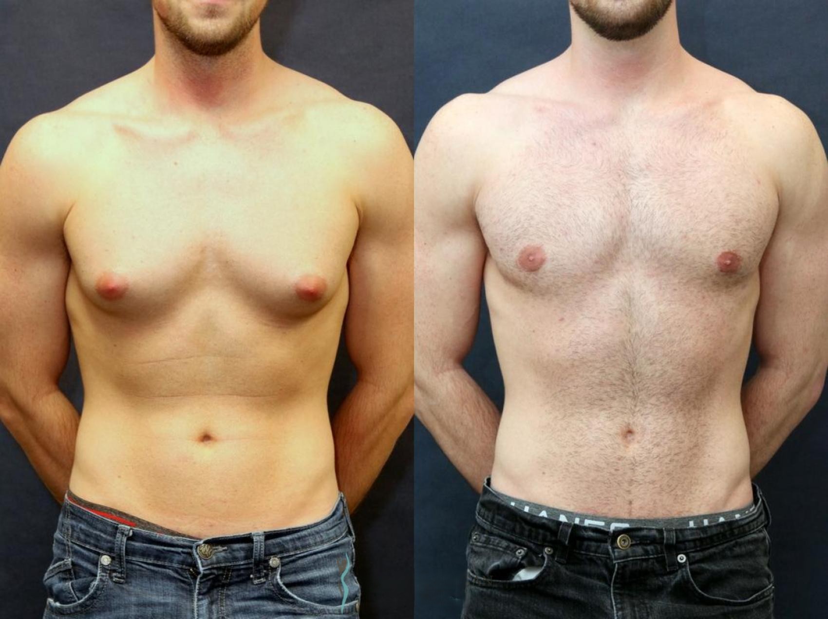 Gynecomastia Surgery by Dr. Uday Kumar Chapa