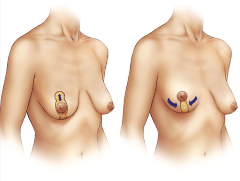 Breast Lift Procedure