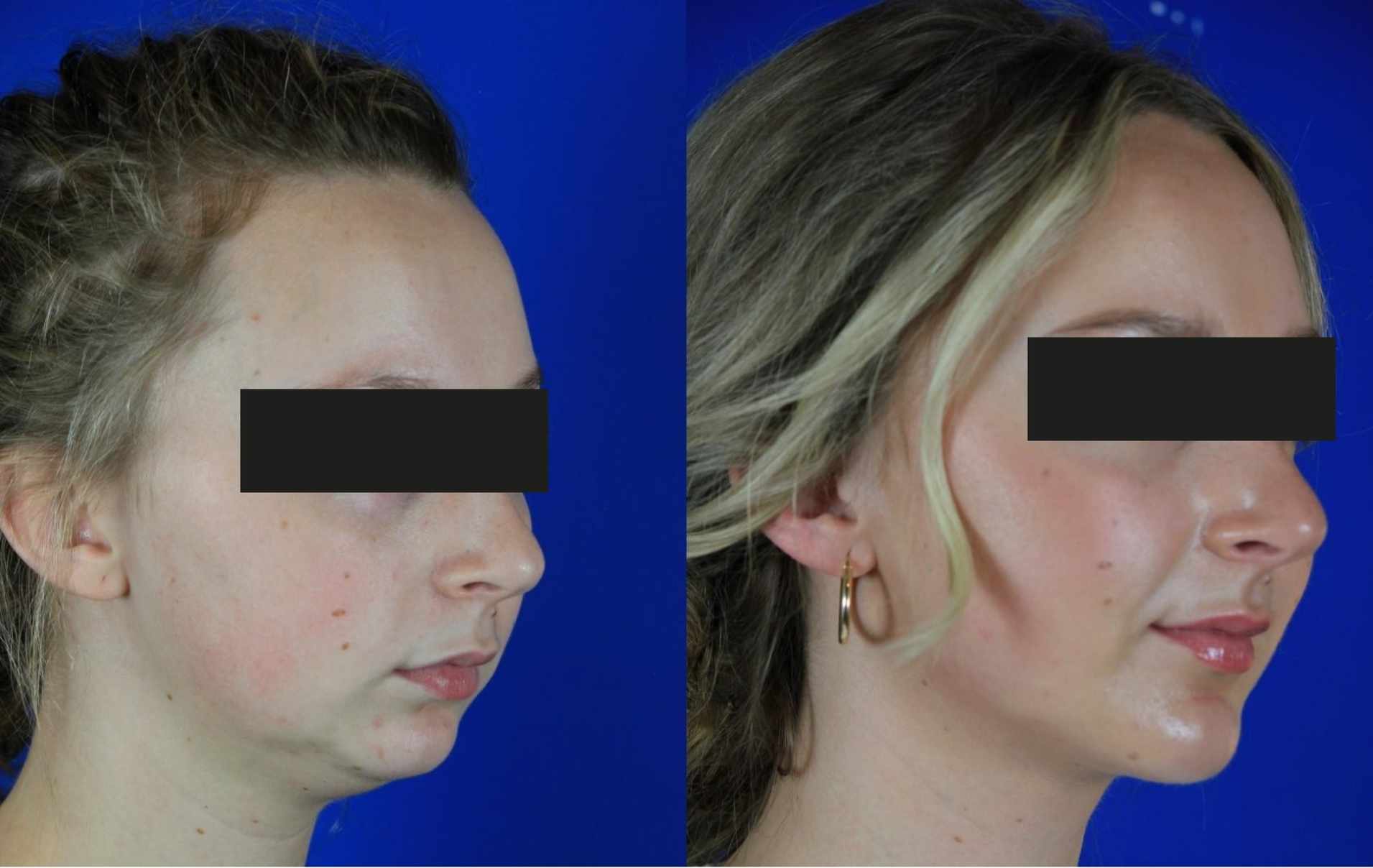 Benefits of Jawline/Chin Implant