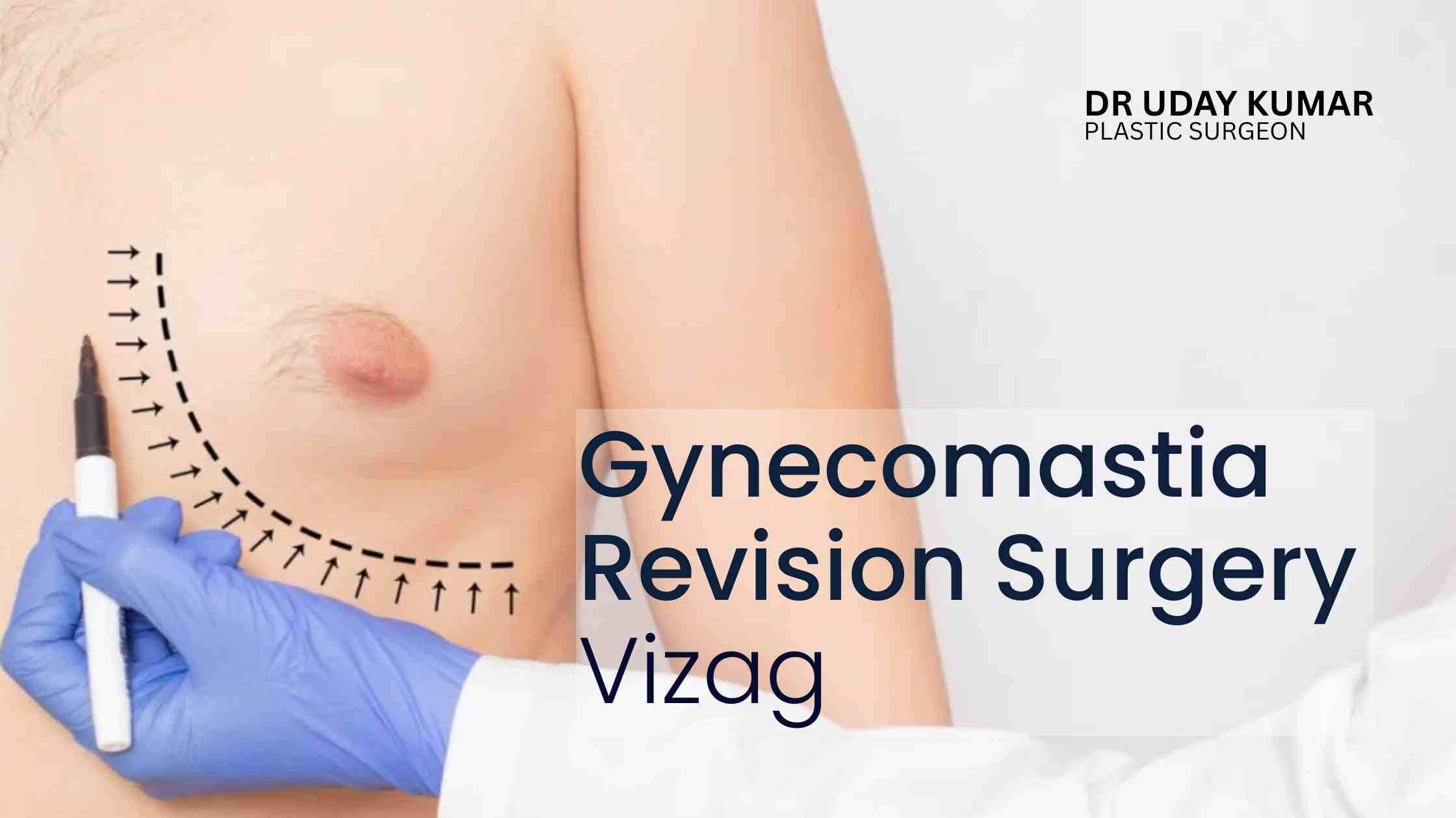 gynecomastia revision surgery Vizag