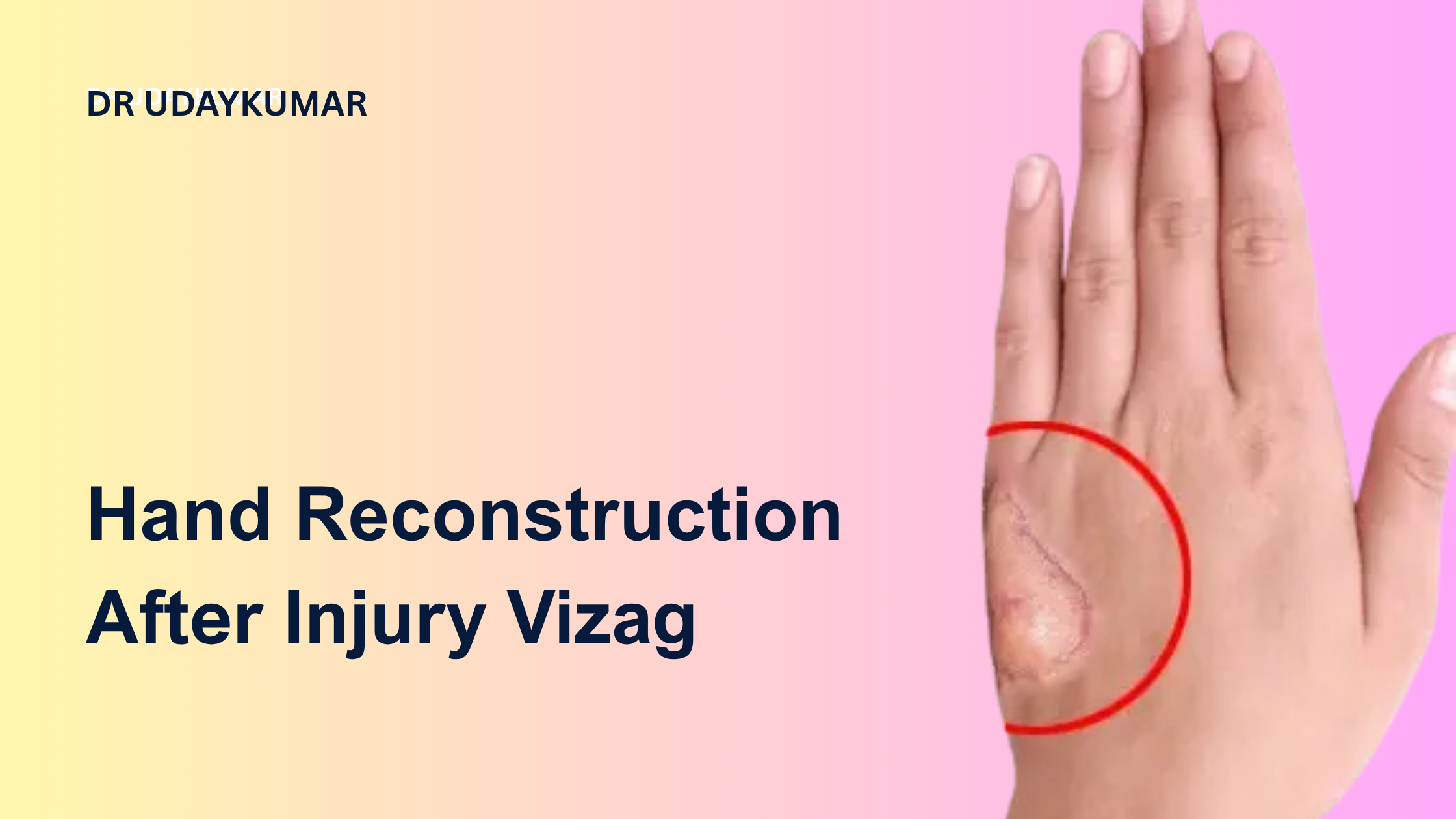 hand reconstruction after injury Vizag